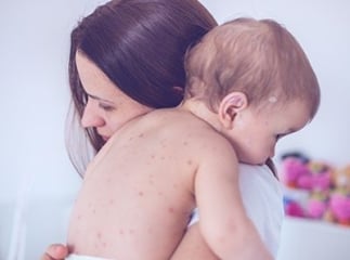 varicelle bébé